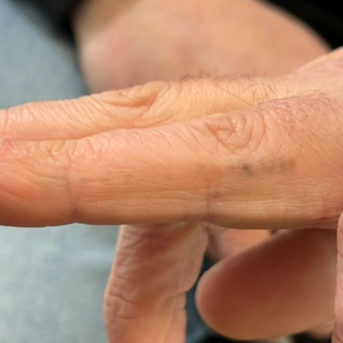 Tattoo on finger after 4 laser removal sessions